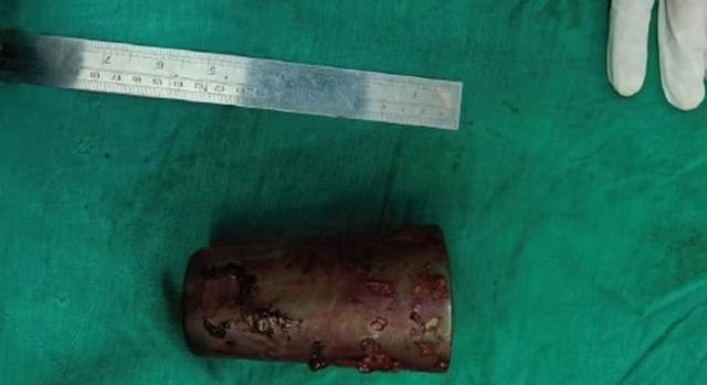 Annyira berúgott a férfi, hogy feldugott egy 12 centis üvegpoharat a saját ánuszába