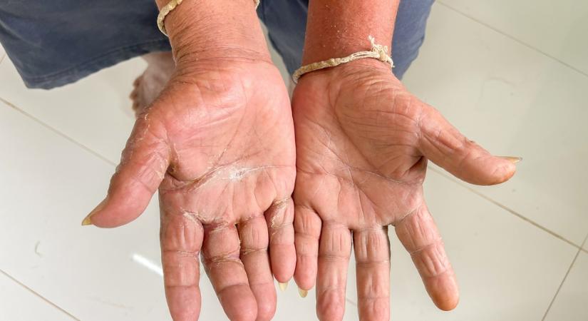 Ennek a bőrbetegségnek kárát látja a tüdő, a szív és a vesék is