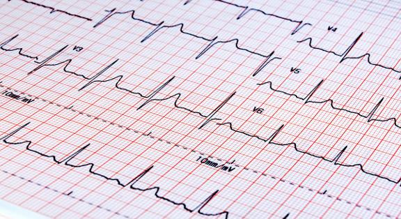Diagnosztikai módszerek - EKG-vizsgálat