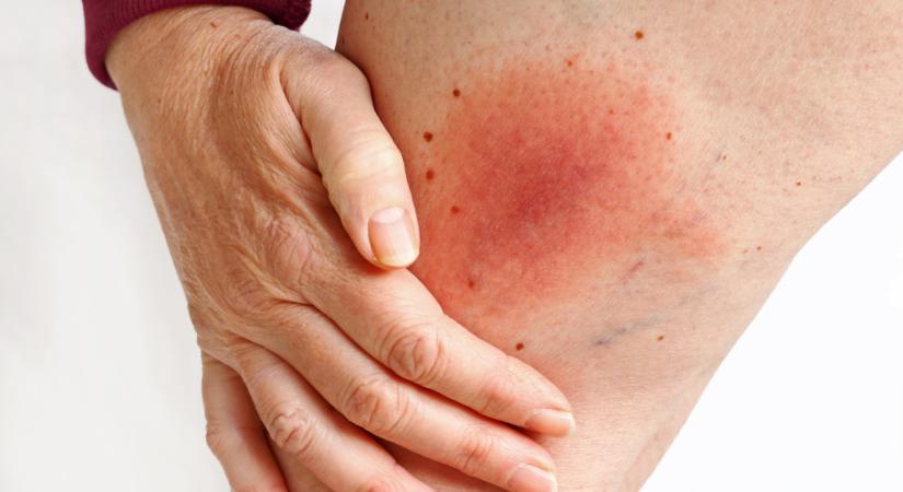 Lyme-kór vagy ízületi gyulladás? Így derítheti ki, mi okozza a ízületi panaszokat