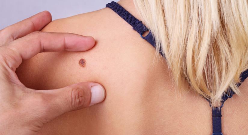 Spinalioma, basalioma, melanoma: melyik képezhet áttétet?