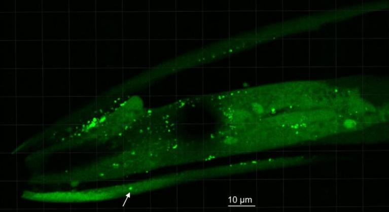 Áttörés: megtalálhatták a Parkinson-kór okozóját