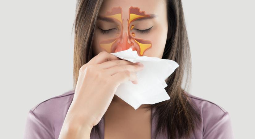 Folyton kiújuló arcüreggyulladás: orrpolip és reflux is lehet az oka