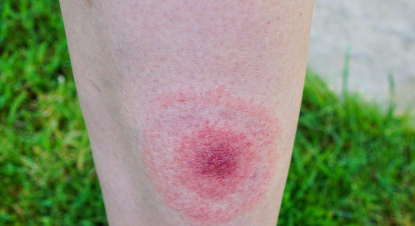 Lyme-kór: ezek a kullancscsípés utáni első stádium tünetei