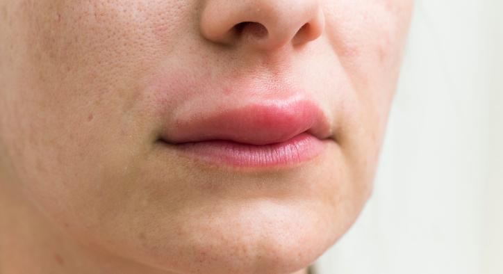 Életveszélyes allergia: így jelzi az arc, ha orvost kell hívnia
