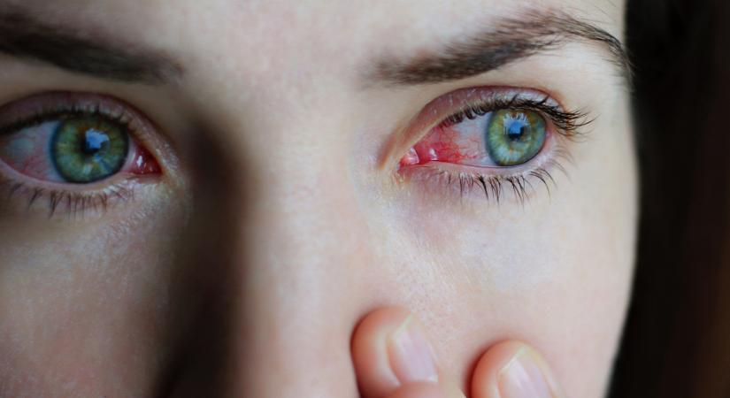 Vörös, száraz, viszkető szem - Így előzheted meg a kötőhártya-gyulladást