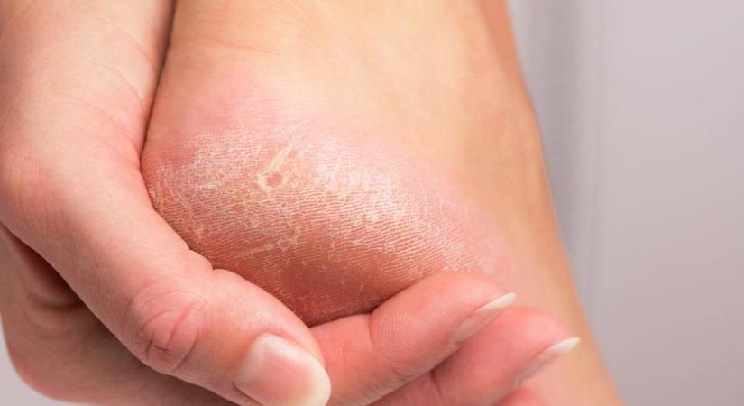 Több betegség tünete lehet a megvastagodott bőr: nem csak a talpon jelentkezhet a hiperkeratosis