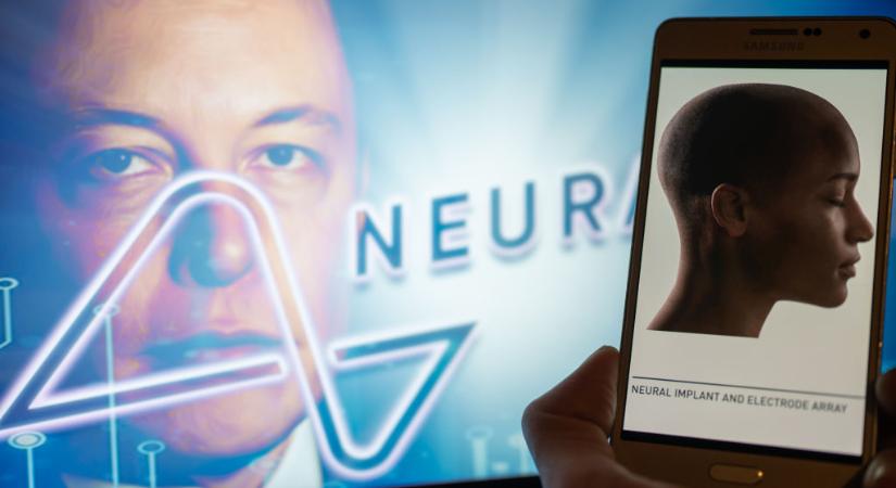 Globál: Elon Musk megcsinálja: emberkísérletet agyba épített chip-pel