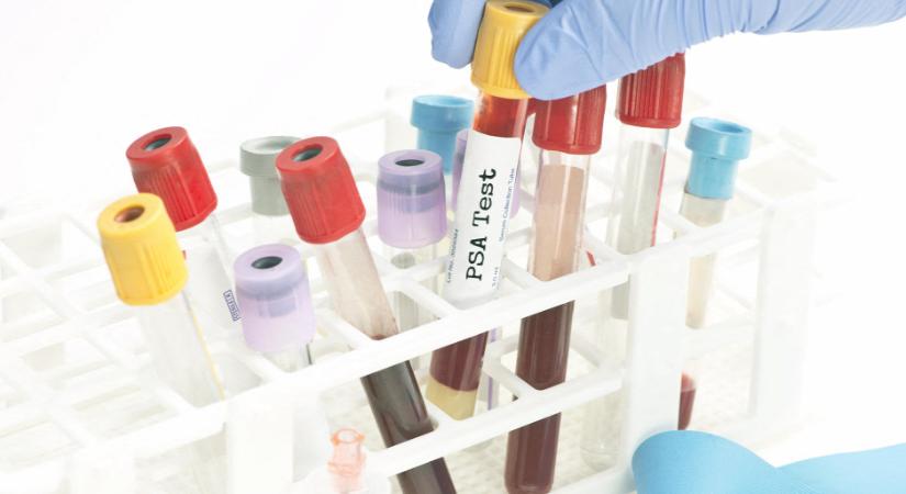 Több mint 50 ráktípust kimutató vérvizsgálatot teszteltek biztató eredményekkel