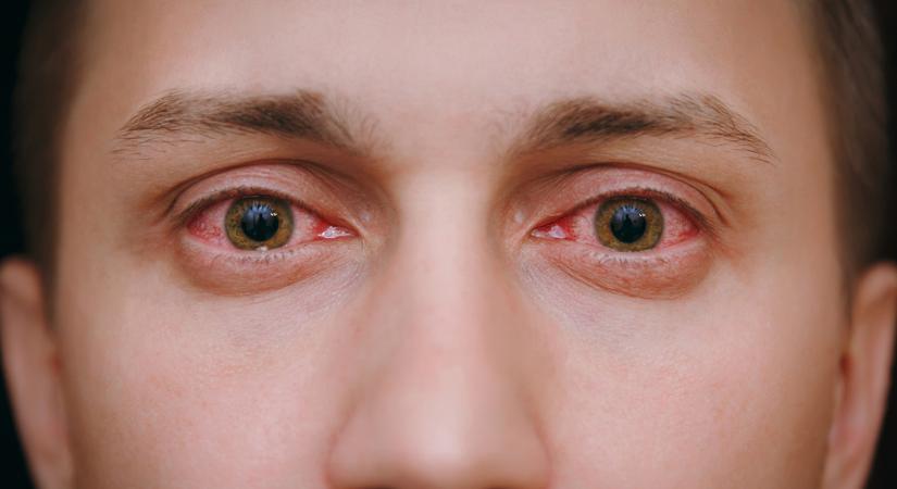 Ha ilyen a szeme, érdemes allergológushoz fordulnia