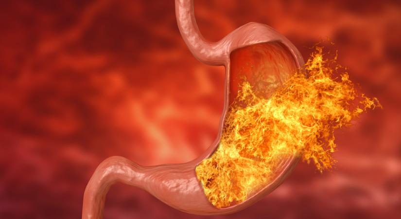 A reflux nem pusztán gyomorégés: kezelés nélkül ilyen szövődményekhez vezet