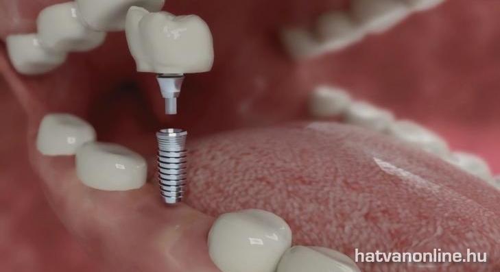 EGÉSZSÉGÜGYI KISOKOS: Fogbeültetés, implantálás 
