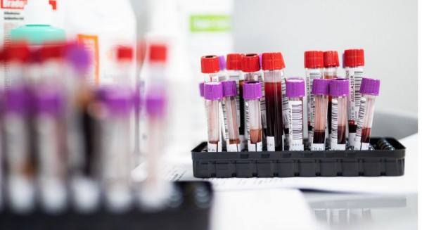Szívizombiopszia helyett egy vérvétel is elegendő a szívtranszplantáltak állapotának nyomon követésére
