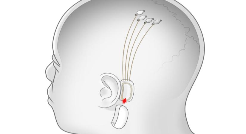 Neuralink: indulhat az emberkísérlet az agyba ültetett lapkákkal
