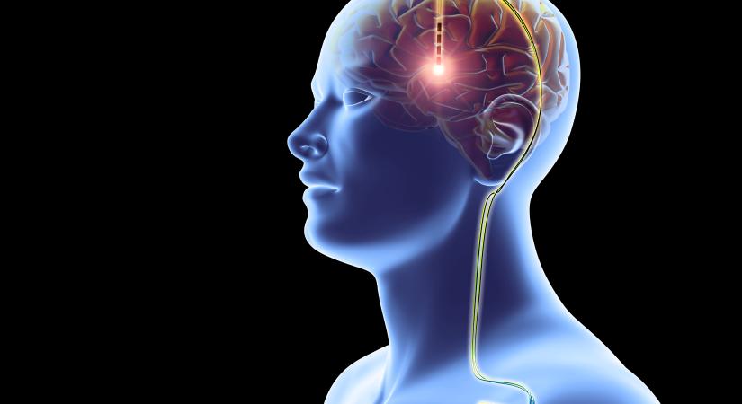 Engedélyt kapott Elon Muskék agyimplantátuma, jöhet a gondolattal irányítás