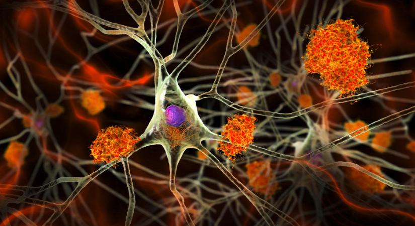 Az Alzheimer-kór korai felismerése minőségi éveket jelenthet a családoknak