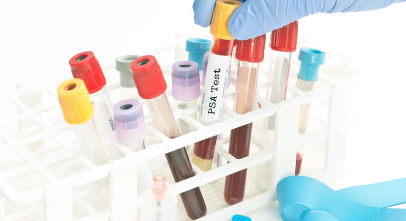 Egyetlen vérvizsgálattal bizonyossá válhat az Alzheimer-kór