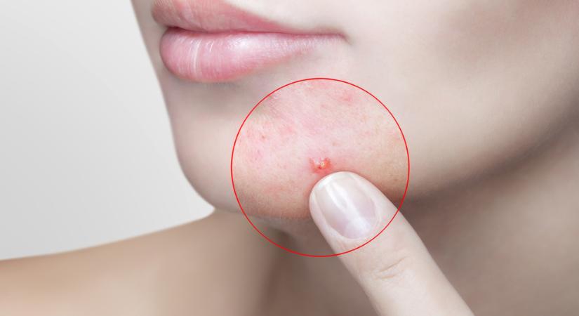 Szteroid okozta akné, pattanás ellen ezek a bőrgyógyász tanácsai