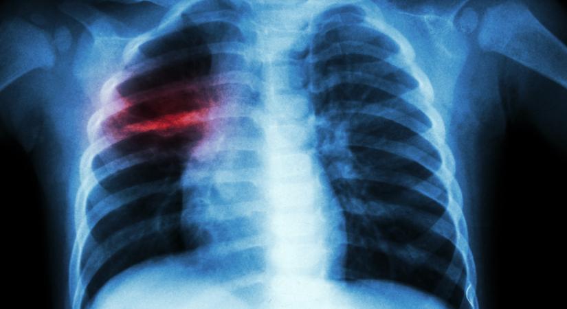 Több tbc-s dolgozót találtak egy magyar gyárban: újra terjedhet a tubercolosis, ismét több a beteg?