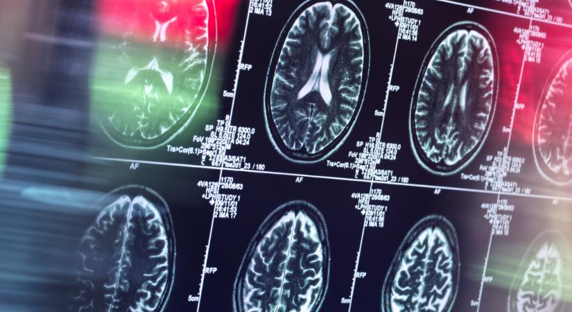 Demencia fenyegeti az ADHD-val diagnosztizált felnőtteket
