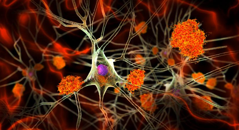 Az agy gombás fertőzése az Alzheimer-kórhoz hasonló tüneteket okozhat