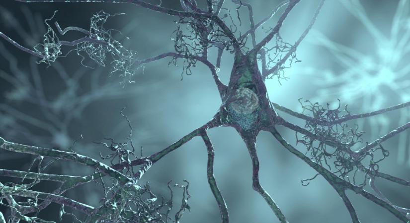 Drámai felfedezés az Alzheimer-kórról