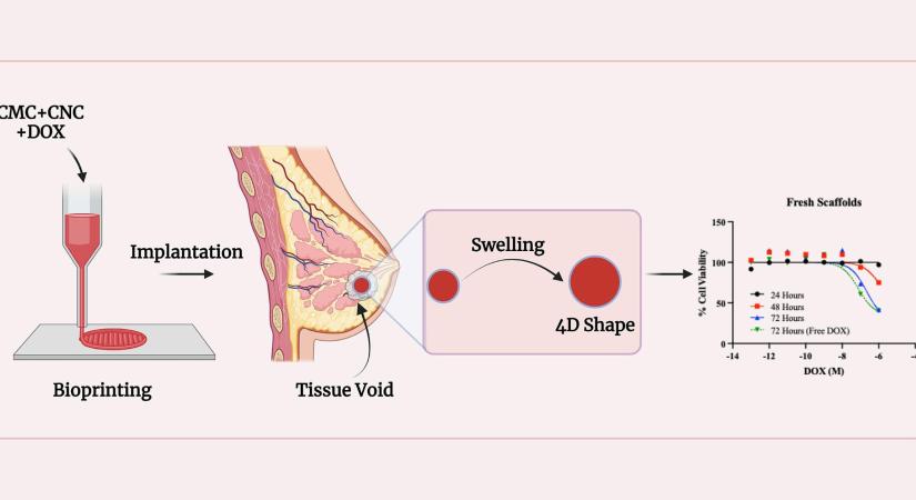 4D nyomtatott implantátumok a mellrák hatékony kezeléshez