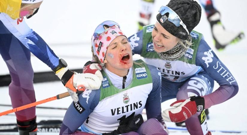 Akár a szemét is kiszúrhatták volna – véres arccal esett össze a célban az olimpiai bajnok sífutó