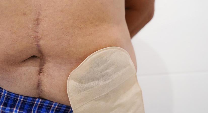 Műhiba miatt élete végéig sztómával kell élnie – 8 éve várja, hogy fizessen neki a kórház