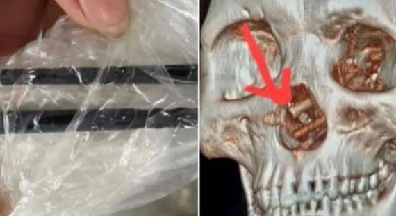 Öt hónapig fájt a feje: kiderült, hogy egy pár evőpálcika volt a koponyájában