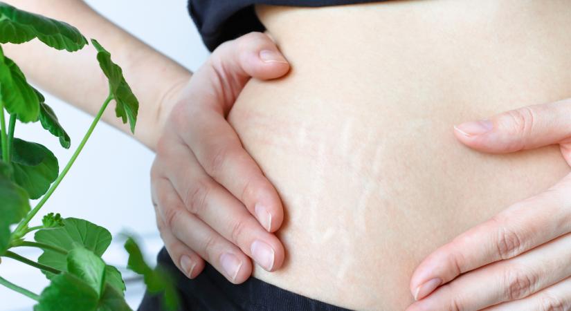 Csíkok a bőrön: striának tűnhetnek, de hormonbetegség is okozhatja őket
