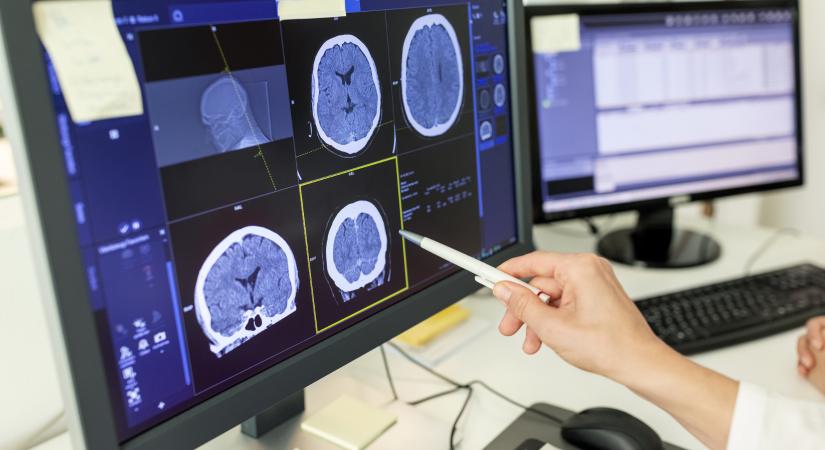 Új kapuk nyíltak meg az agydaganat diagnosztizálására: így növelheti a túlélési arányt