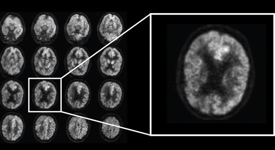 Betiltották a kezelést, miután kiderült: agyról agyra is átterjedhet az Alzheimer-kór