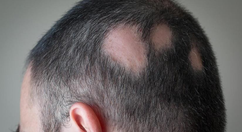 Rejtélyes hajhullás: harc a kopasz foltok ellen
