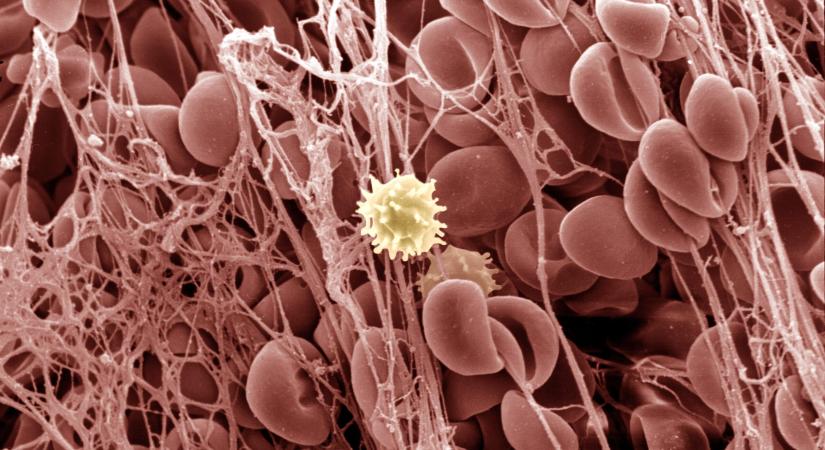A fiatal koronavírus-fertőzöttek szervezetében is megjelenhetnek a vérrögök
