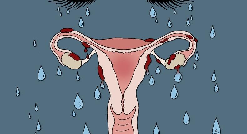 Az izraeli Gynica megkezdte az endometriózis gyógyításának klinikai vizsgálatát