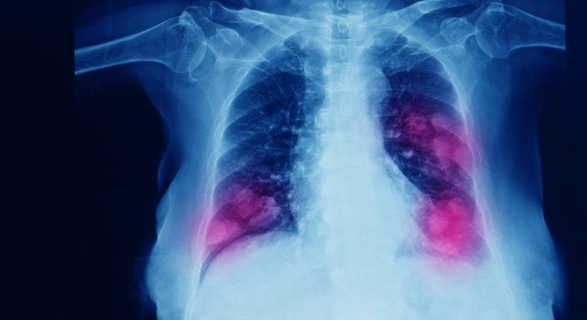 Tüdőrák: ez a kezelés növelheti a túlélési esély