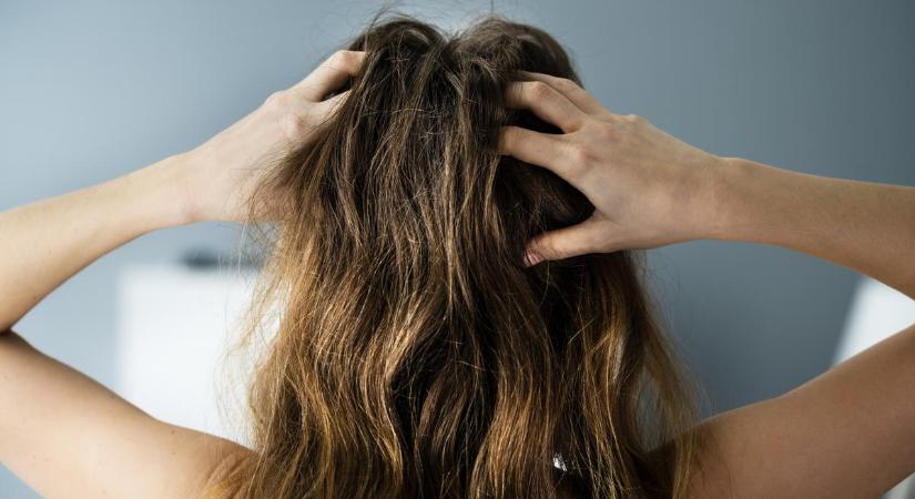 5 meglepő ok, ami miatt viszkethet a fejbőröd
