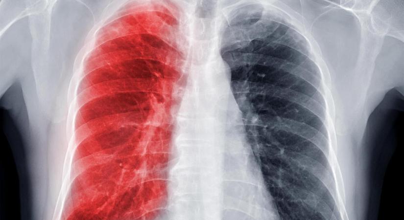 Itt van 10 meglepő tény a tbc-ről: ezeket biztosan nem tudta