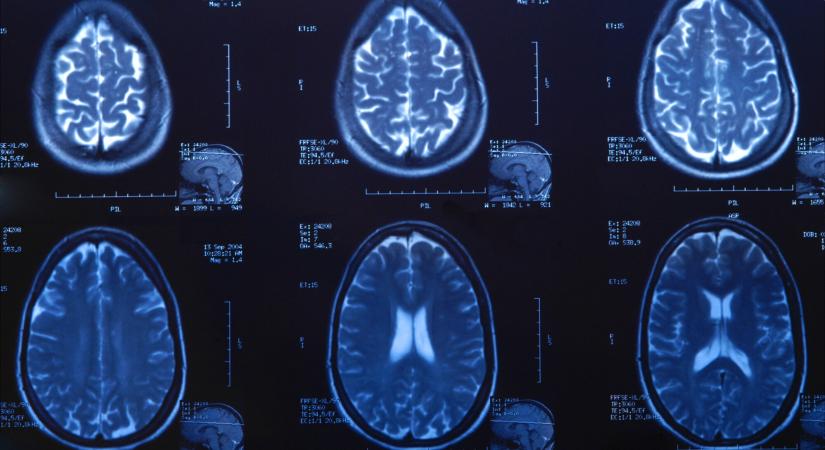 Nem múlt a férfi migrénje, parazitát találtak az agyában