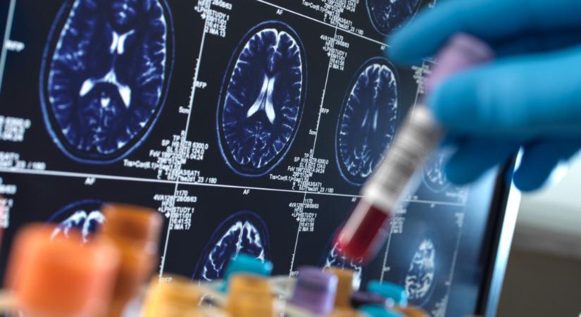 10-15 évvel a tünetek megjelenése előtt kimutatható az Alzheimer-kór egy magyar kombinált teszttel