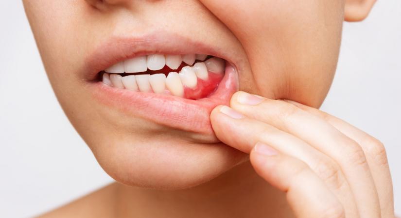 Gyakran vérző fogíny, romló fogak: így növelhetik a daganat esélyét