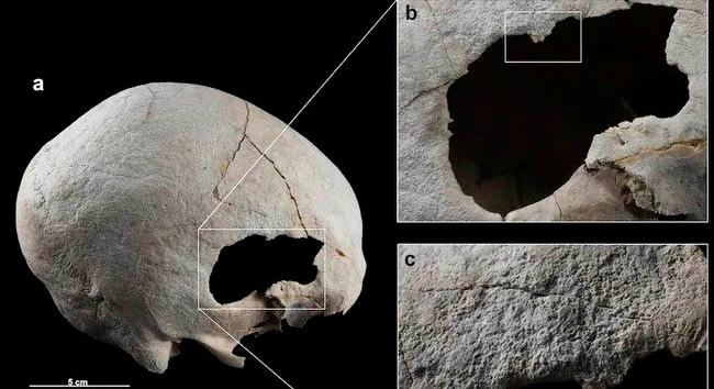 Egy rézkori nő túlélt két koponya műtétet 4.500 évvel ezelőtt