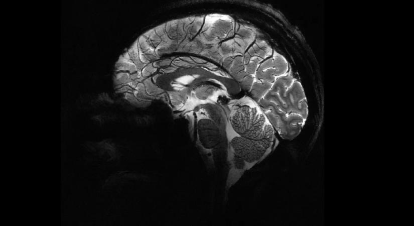 Tűpontos agyi felvétel: beüzemelték a világ legerősebb MRI gépét