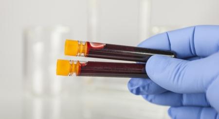 CRC: a korai felismerésben segít egy új DNS-alapú vérvizsgálat