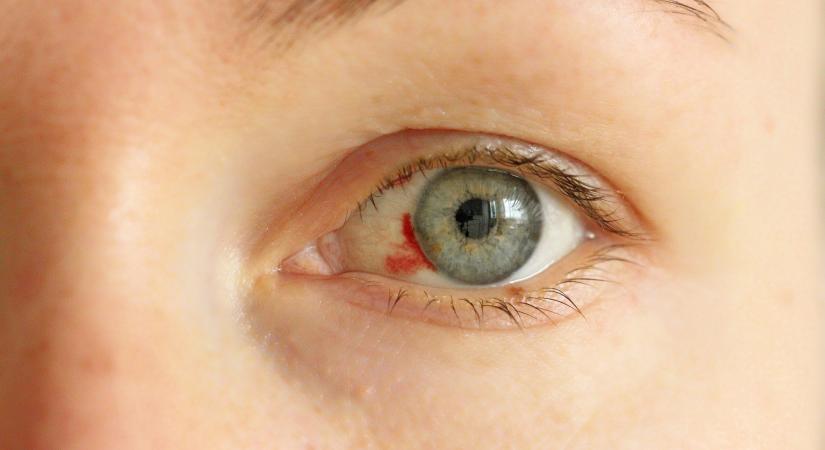 Bevérzés a szemen: mikor jelez trombózist? A szemész szakorvos elmondja