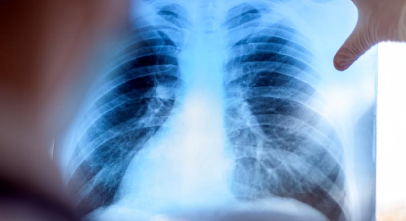 Mitől lehet árnyék a tüdőn? Csomó a tüdőben - nem csak daganatot jelezhet!