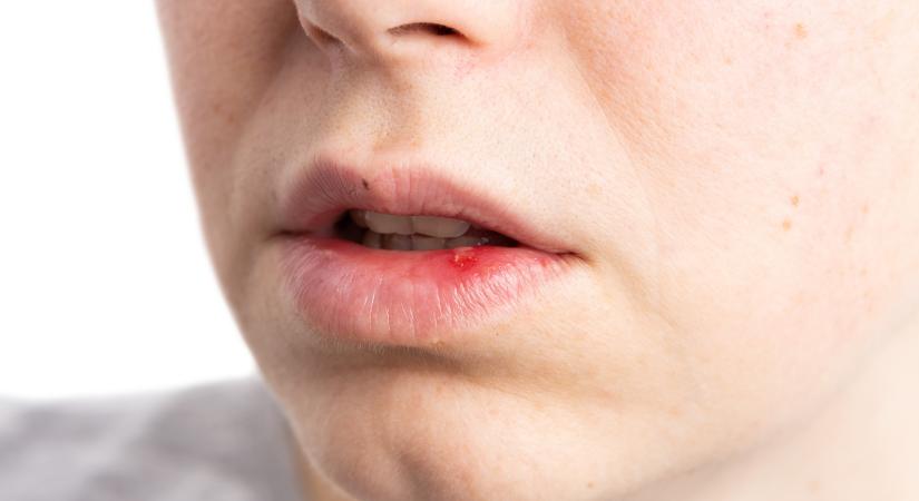Apró kiütések, hólyagok, dudorok a szájon: ezek a betegségek okozhatják
