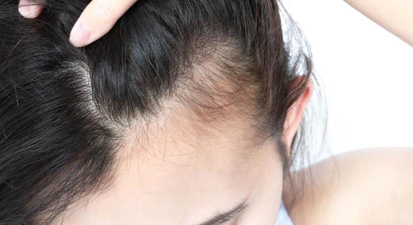 Bőrgyógyászok figyelmeztetnek! Ezt árulja el a fejbőr az egészségedről