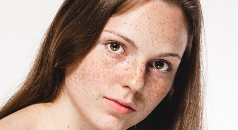 Apró, barna foltok az arcon - Így kezelheted az egyik leggyakoribb bőrproblémát, a hiperpigmentációt
